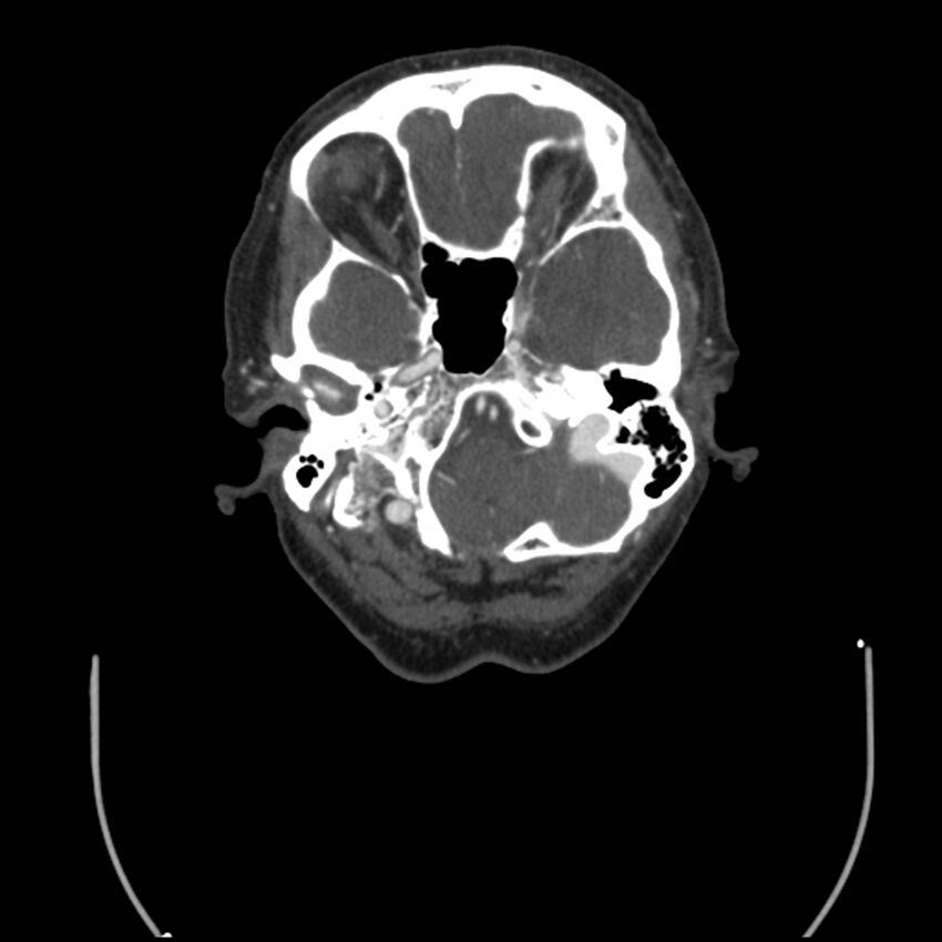 Acute M1 occlusion with ischemic penumbra (CT perfusion) (Radiopaedia 71897-82344 Axial C+ arterial phase thins 127).jpg
