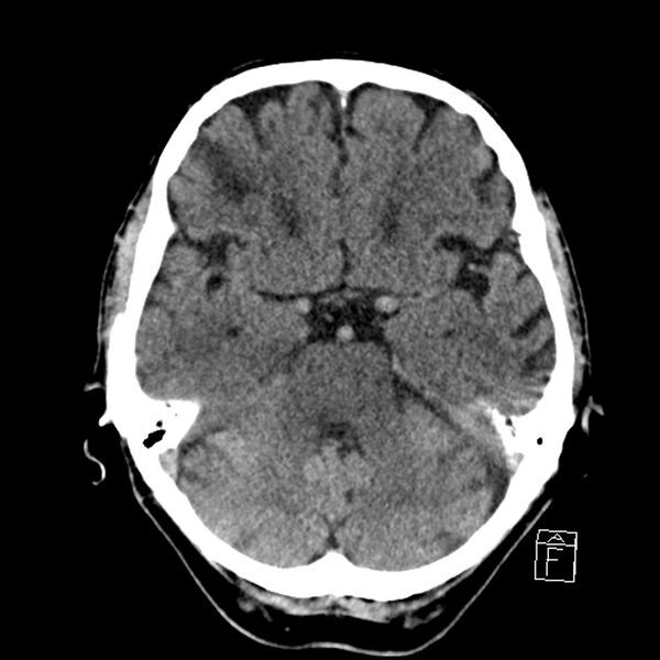 File:Acute P1 occlusion with PCA ischemia penumbra (CT perfusion) (Radiopaedia 72084-82586 Axial non-contrast 13).jpg