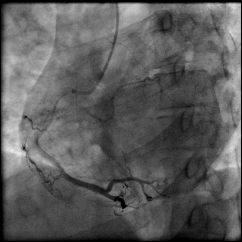 Acute anteroseptal myocardial infarction (Radiopaedia 68409-77946 RAO straight RCA 49).jpg