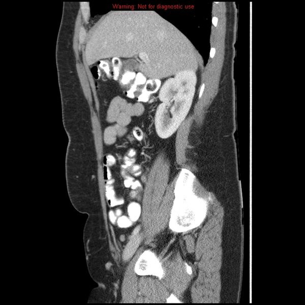 File:Acute appendicitis (Radiopaedia 7966-8812 B 6).jpg
