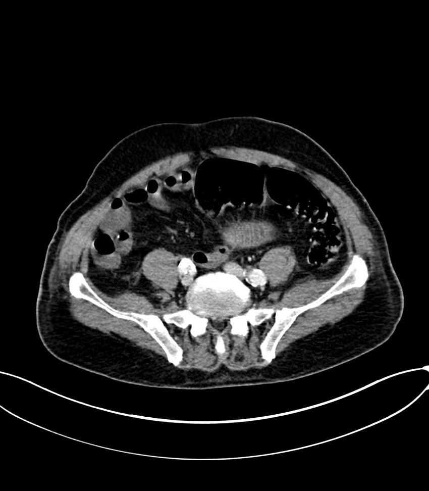 Acute arterial mesenteric ischemia (Radiopaedia 78238-90828 Axial C+ portal venous phase 101).jpg