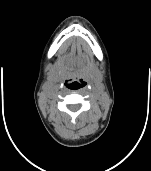 File:Acute bacterial tonsillitis (Radiopaedia 22882-22908 Axial non-contrast 29).png