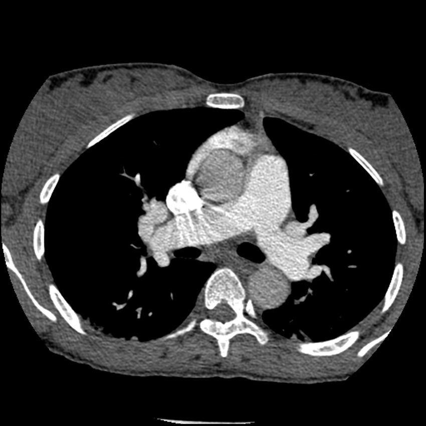 Acute chest syndrome - sickle cell disease (Radiopaedia 42375-45499 Axial C+ CTPA 79).jpg