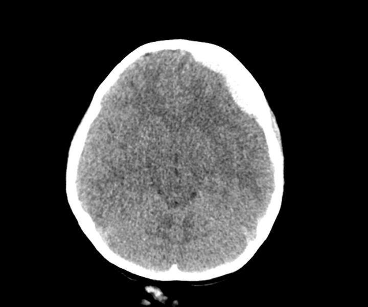 File:Acute epidural hematoma (Radiopaedia 63659-72335 Axial non-contrast 7).jpg