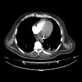 Acute heart failure (CT) (Radiopaedia 79835-93075 Axial C+ arterial phase 34).jpg