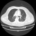 Acute heart failure (CT) (Radiopaedia 79835-93075 Axial lung window 21).png