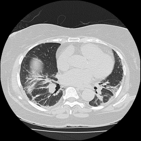 File:Acute interstitial pneumonitis (Radiopaedia 45404-49452 Axial lung window 54).jpg