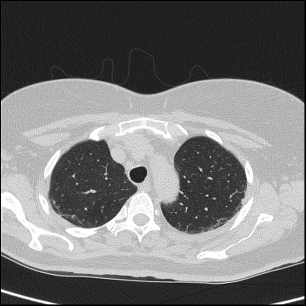 File:Acute interstitial pneumonitis (Radiopaedia 45404-49453 Axial lung window 19).jpg
