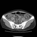 Acute myocarditis (Radiopaedia 55988-62613 Axial C+ portal venous phase 59).jpg