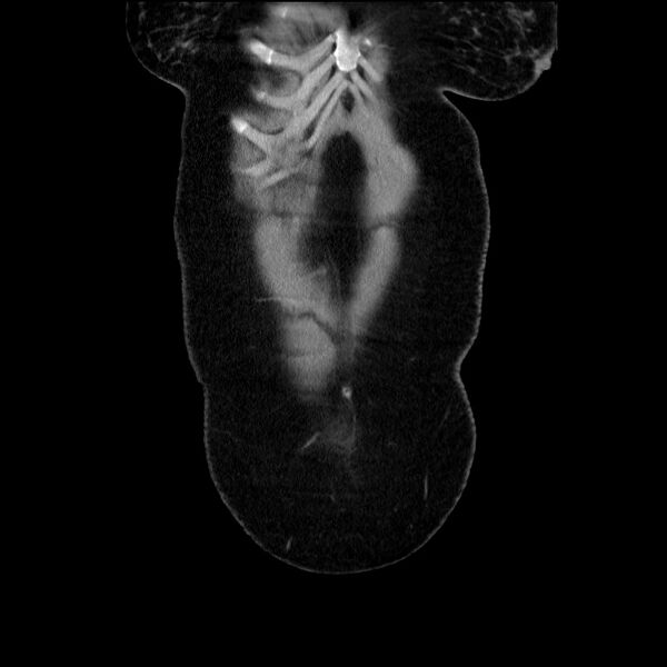 File:Acute pancreatitis (Radiopaedia 69236-79012 Coronal C+ portal venous phase 64).jpg