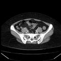 Acute pancreatitis - Balthazar C (Radiopaedia 26569-26714 Axial C+ portal venous phase 74).jpg