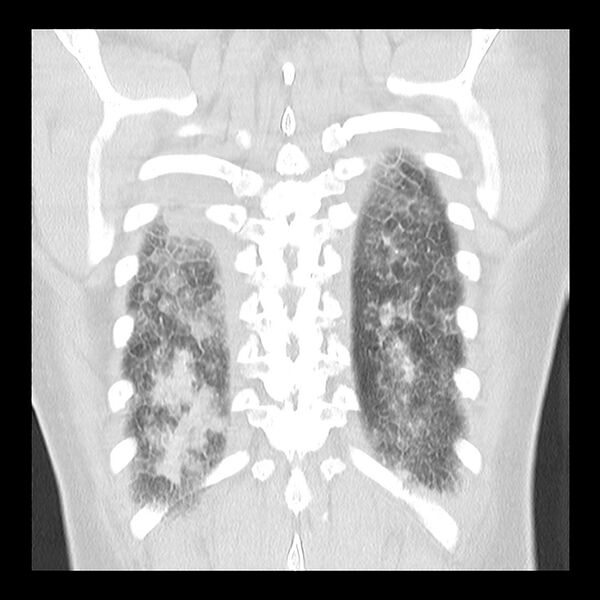 File:Acute pulmonary edema on CT (Radiopaedia 33582-34672 Coronal lung window 33).jpg