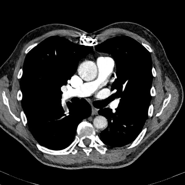 File:Acute pulmonary embolism (Radiopaedia 81677-95570 Axial C+ CTPA 42).jpg