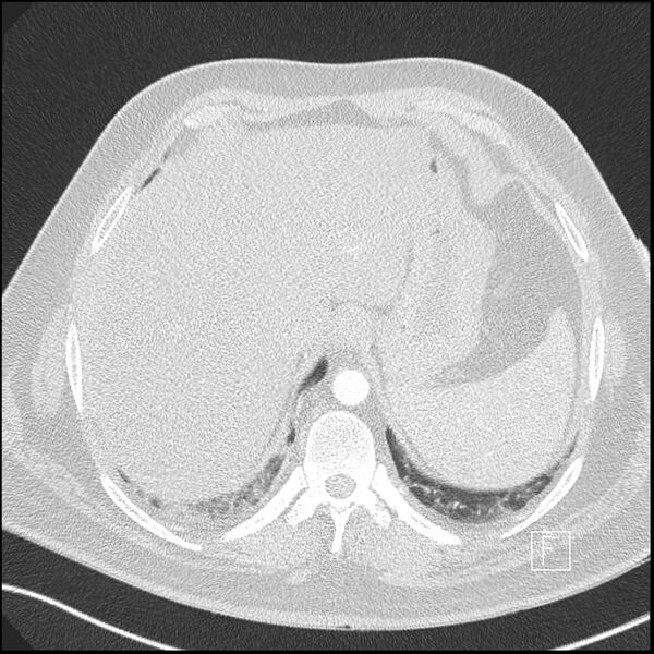 File:Acute pulmonary embolism with pulmonary infarct (Radiopaedia 73062-83768 Axial lung window 25).jpg
