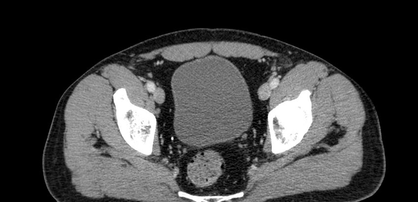 Acute sigmoid colon diverticulitis (Radiopaedia 55507-61976 Axial C+ portal venous phase 106).jpg
