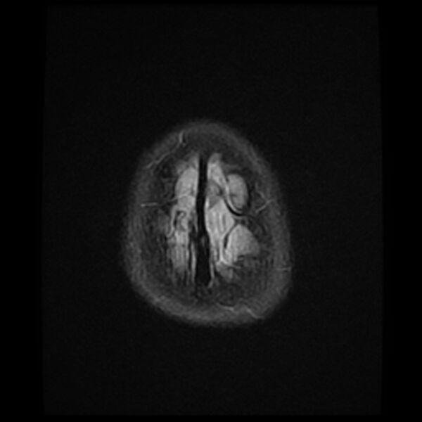 File:Adamantinomatous craniopharyngioma (Radiopaedia 77407-89529 Axial FLAIR 24).jpg
