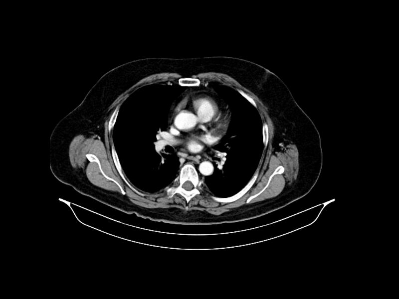 File:Adenocarcinoma of pancreas with hepatic metastasis (Radiopaedia 64332-73122 Axial C+ portal venous phase 3).jpg