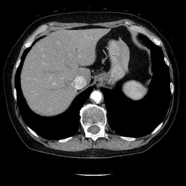 File:Adenocarcinoma of the lung (Radiopaedia 41015-43755 Axial C+ portal venous phase 108).jpg