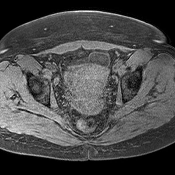 File:Adenomyoma of the uterus (Radiopaedia 9871-10439 Axial T1 fat sat 10).jpg