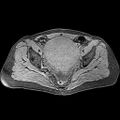 Adenomyoma of the uterus (huge) (Radiopaedia 9870-10438 Axial T1 fat sat 15).jpg
