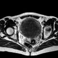 Adenomyoma of the uterus (huge) (Radiopaedia 9870-10438 Axial T2 15).jpg