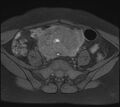 Adenomyosis - ovarian endometriomas (Radiopaedia 67031-76350 Axial T1 fat sat 7).jpg