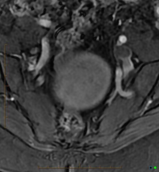 File:Adenomyosis uterus with hematometra (Radiopaedia 45779-50011 Axial T1 C+ fat sat 5).jpg