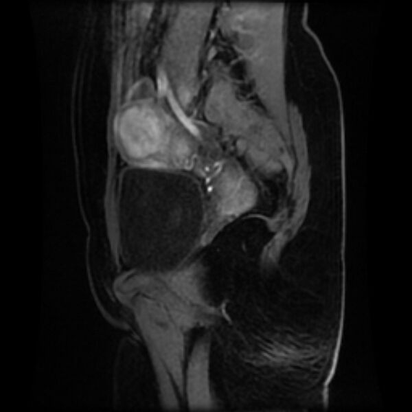 File:Adenomyosis within a septate uterus (Radiopaedia 69963-79981 Sagittal LAVA-Dyn 24).jpg