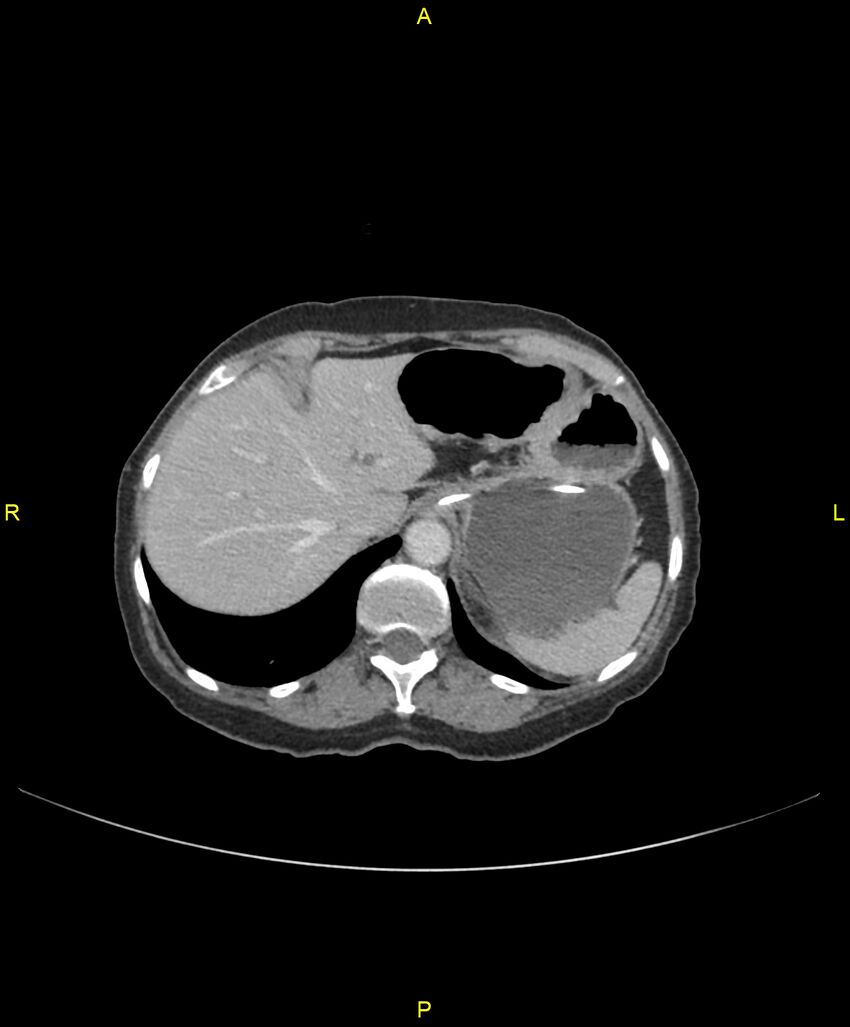 Adhesional small bowel obstruction (Radiopaedia 85402-101024 Axial C+ portal venous phase 53).jpg