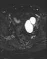 Adnexal multilocular cyst (O-RADS US 3- O-RADS MRI 3) (Radiopaedia 87426-103754 Axial T2 fat sat 13).jpg
