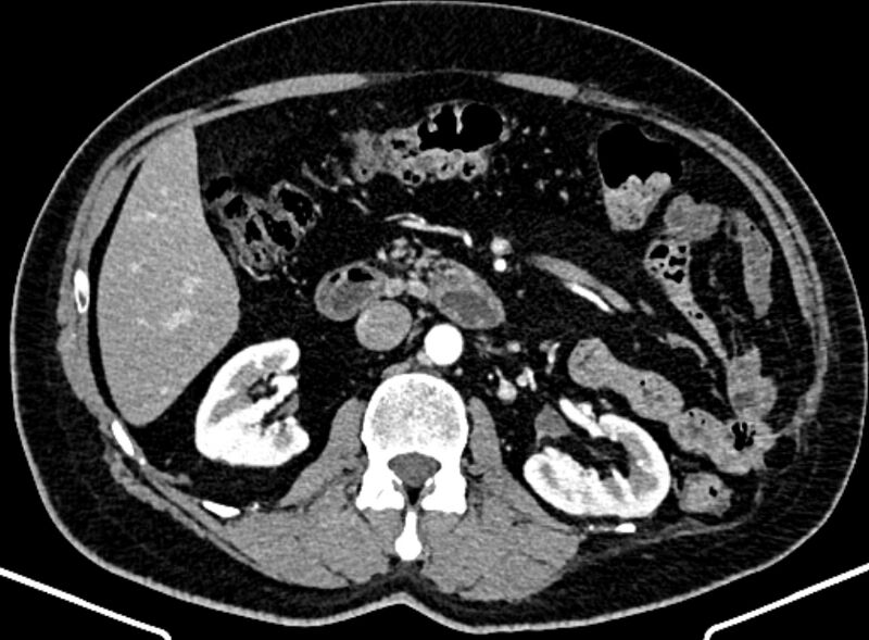 File:Adrenal metastases (Radiopaedia 73082-83791 Axial C+ arterial phase 76).jpg