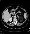 Adrenal myelolipoma (Radiopaedia 6765-7960 Axial C+ arterial phase 12).jpg