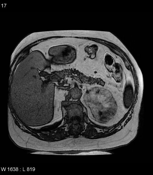 File:Adrenal myelolipoma (Radiopaedia 6765-7961 Axial T1 out-of-phase 17).jpg