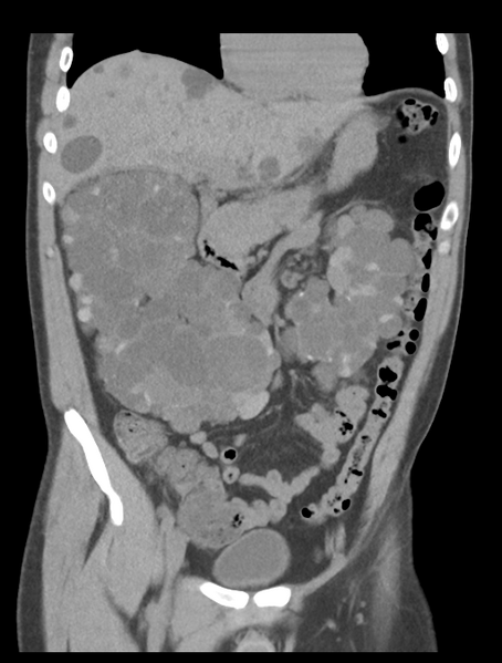 File:Adult polycystic kidney disease (Radiopaedia 47866-52626 Coronal non-contrast 16).png