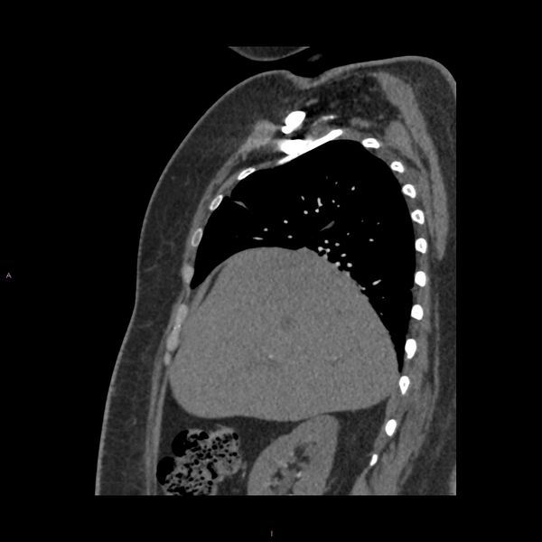 File:Agenesis of the left hepatic lobe (Radiopaedia 77284-89359 Sagittal C+ CTPA 31).jpg