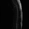 Aggressive vertebral hemangioma (Radiopaedia 39937-42404 Sagittal T2 9).png