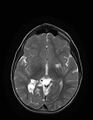 Aicardi syndrome (Radiopaedia 66029-75205 Axial T2 12).jpg