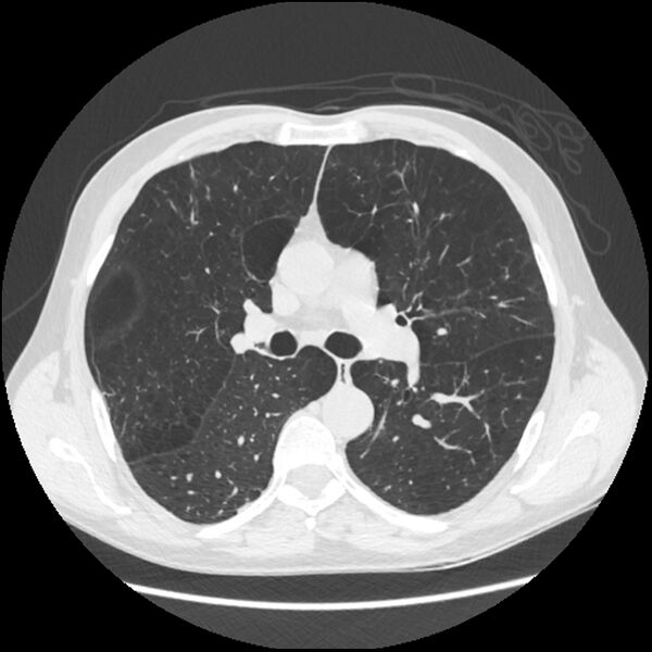 File:Alpha-1-antitrypsin deficiency (Radiopaedia 40993-43722 Axial lung window 102).jpg