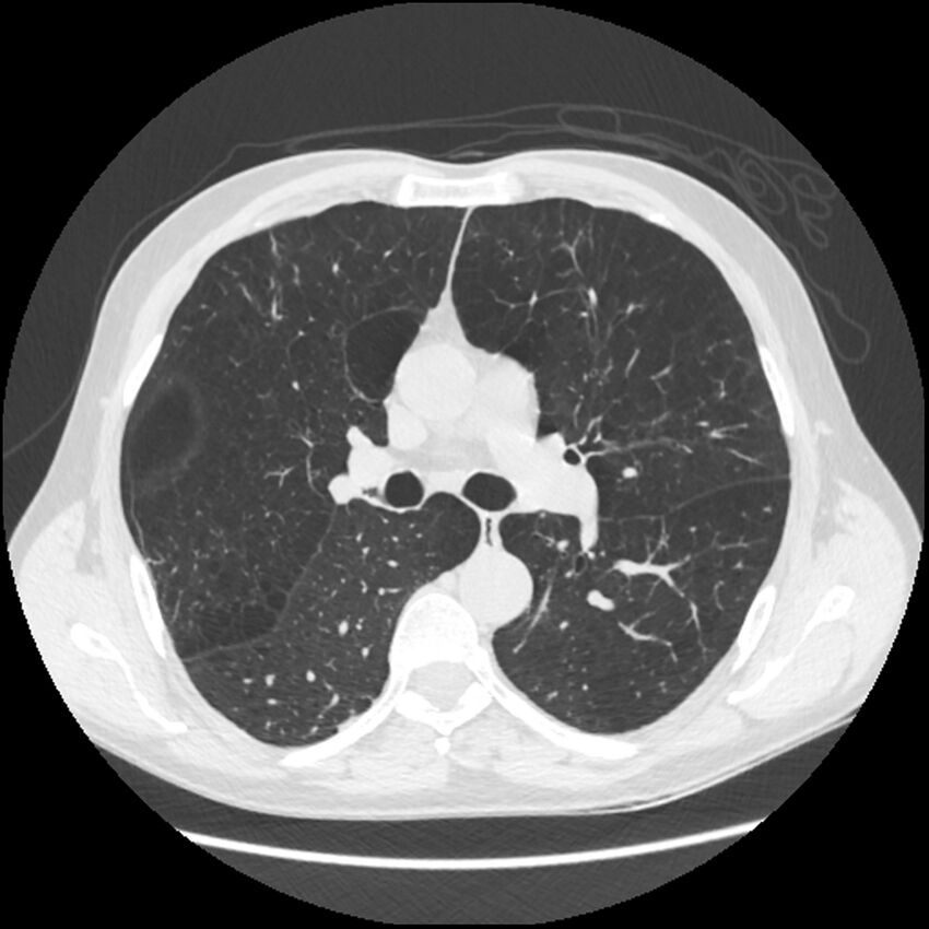 Alpha-1-antitrypsin deficiency (Radiopaedia 40993-43722 Axial lung window 102).jpg