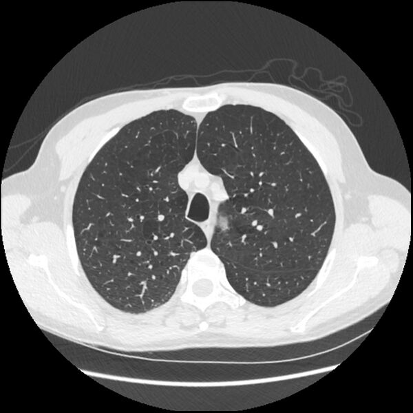 File:Alpha-1-antitrypsin deficiency (Radiopaedia 40993-43722 Axial lung window 55).jpg