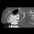 Ameloblastic fibro-odontoma (Radiopaedia 18843-18780 bone window 10).jpg