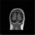 Amnestic syndrome secondary to hypoxic brain injury (Radiopaedia 24743-25004 B 2).jpg
