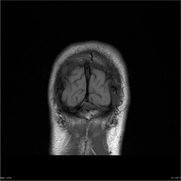 File:Amnestic syndrome secondary to hypoxic brain injury (Radiopaedia 24743-25004 B 2).jpg