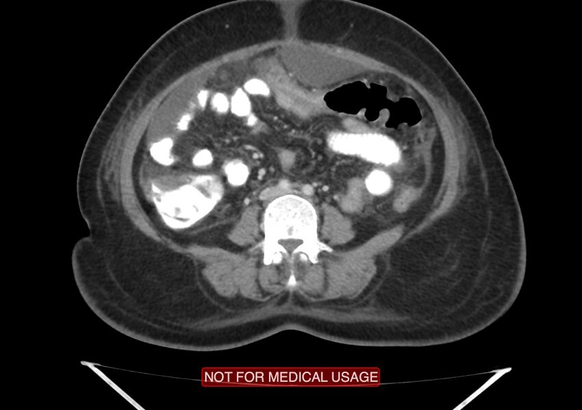 Amoebic enterocolitis with liver abscess (Radiopaedia 35100-36609 A 49).jpg