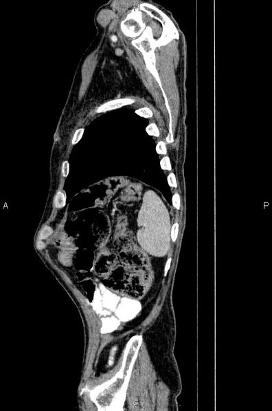 File:Ampullary adenocarcinoma (Radiopaedia 86093-102033 E 82).jpg