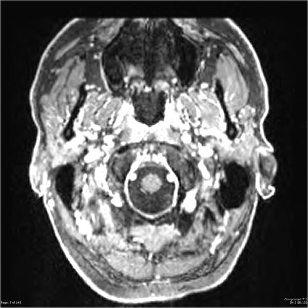 File:Anaplastic meningioma with recurrence (Radiopaedia 34452-35788 Axial T1 C+ 3).jpg