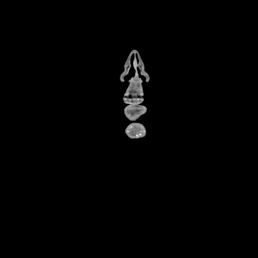Anaplastic thyroid carcinoma (Radiopaedia 79087-92034 A 15).jpg
