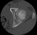 Aneurysmal bone cyst of ischium (Radiopaedia 25957-26094 B 9).png