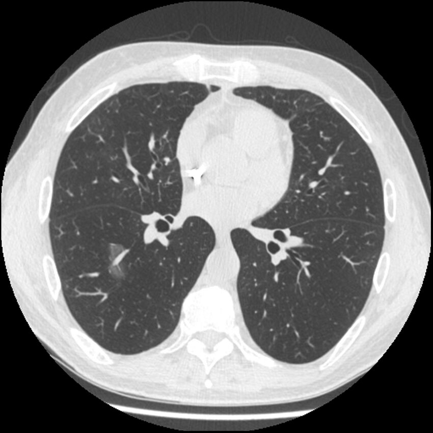Angioinvasive aspergillosis (Radiopaedia 43957-47466 Axial lung window 39).jpg