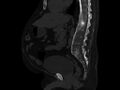 Ankylosing spondylitis (Radiopaedia 44609-48357 Sagittal bone window 53).jpg